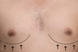 MALE breast enhancement