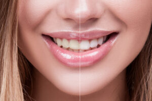 What To Eat After Teeth Whitening