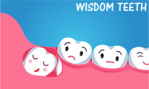 Wisdom tooth affecting its neighboring teeth. Preparing for wisdom tooth surgery is essential.