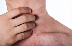 stress rashes