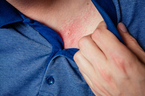 Stress Related Rashes: Everything You Need to Know